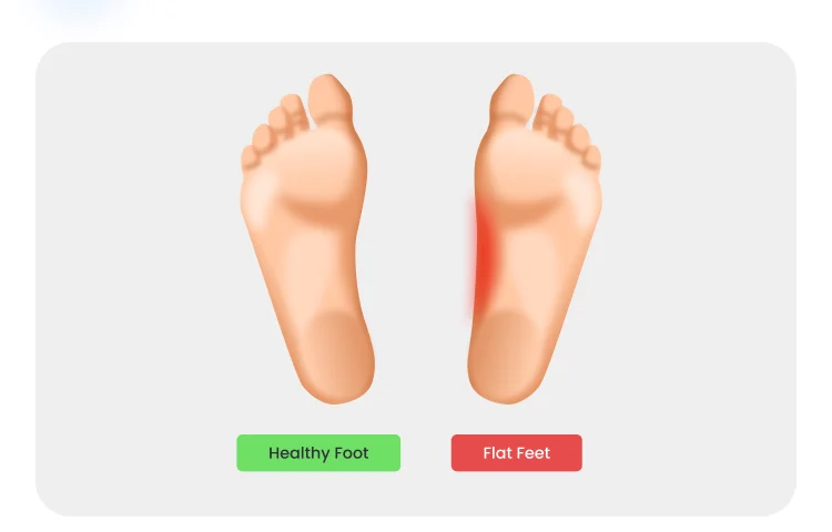 Hike illustration for flat feet: two soles side by side, labelled Healthy Foot and Flat Feet, the flat one marked red along the arch